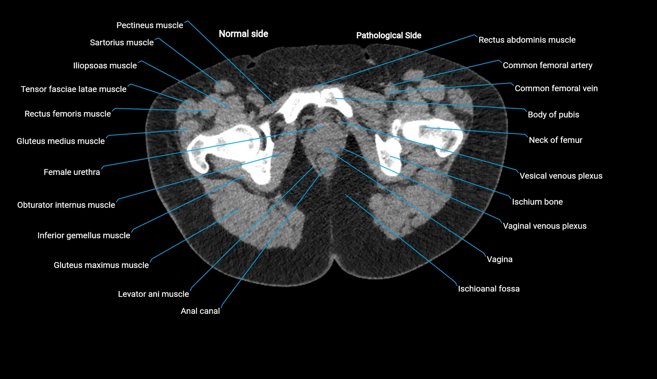 CT KUB axial cross sectional anatomy  radiology image -img-00201-00170.webp